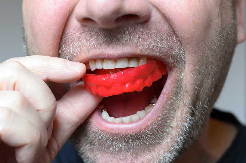 Mouth Guards in Airdrie for Bruxism