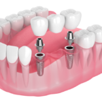 Replace missing teeth with dental implants in Airdrie. Strong, natural-looking results with expert care. Book dental implants near you today.