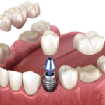 Find expert dental crowns and bridges in Airdrie. Get personalized, high-quality restorative care near you for lasting results.