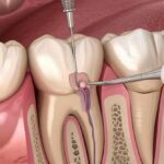 Root Canal Therapy: Safe, Effective, and Pain-Free Solutions