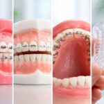 What Are The 4 Types Of Dental Braces