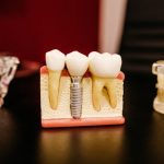 dental implant model illustrating tooth replacement compared with traditional dentures